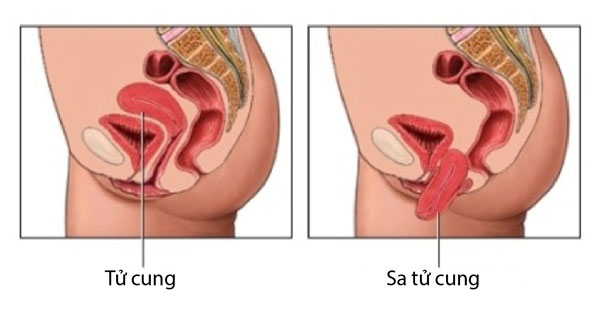 Phẫu thuật nội soi phục hồi nhanh sa niệu – sinh dục với mảnh ghép đặc biệt