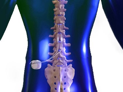 Spinal Cord Stimulators vs. Intrathecal Pumps for Chronic Back Pain