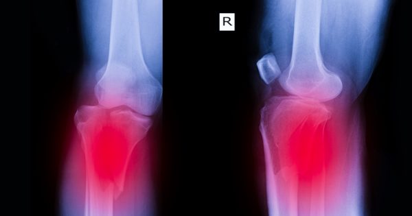 What are the symptoms and signs of a broken knee cap?