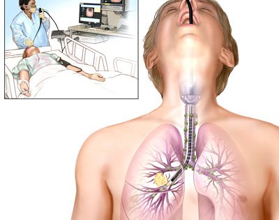 Có những biến chứng nào có thể xảy ra sau nội soi phổi?
