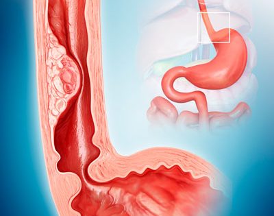 Quy trình phẫu thuật ung thư thực quản và những lưu ý cần biết