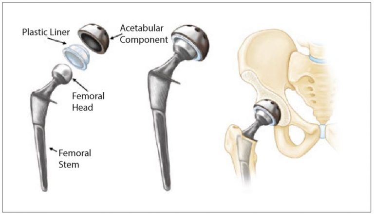 Hip Replacement - FV Hospital