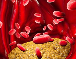 Những bệnh gì liên quan đến mức độ cholesterol và triglyceride cao trong máu?
