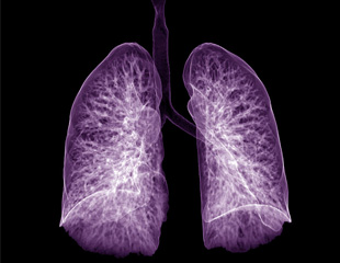 Low Dose CT Lung Cancer Screening