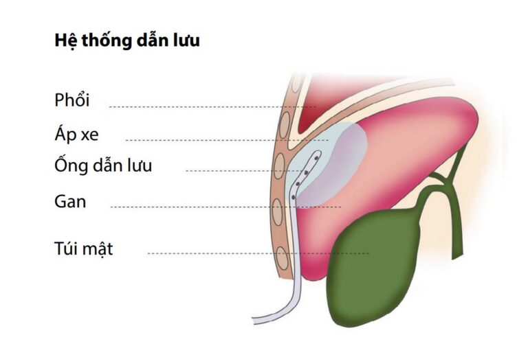 Dẫn lưu áp xe qua da