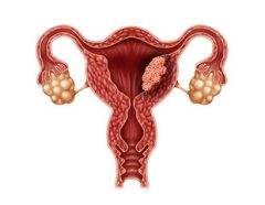 Cervical Cancer