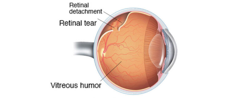 Retinal Detachment