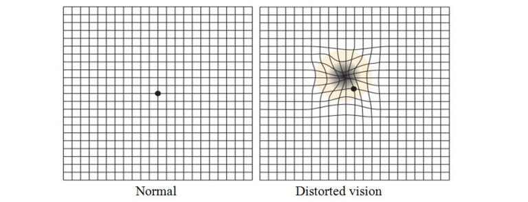 Age-Related Macular Degeneration - FV Hospital