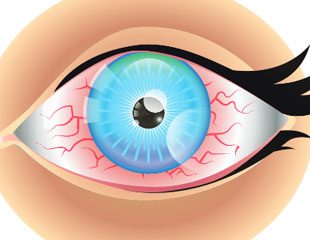 Làm thế nào để nhận biết những dấu hiệu điển hình của khô mắt?
