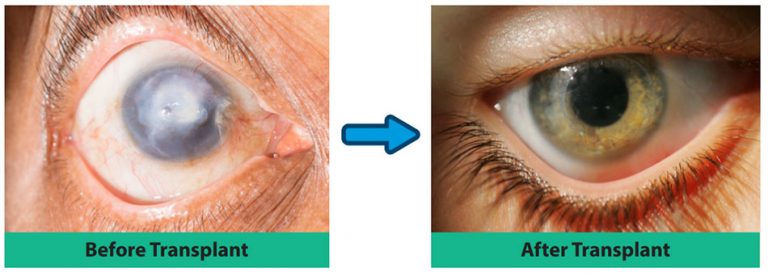 Corneal Transplantation Fv Hospital