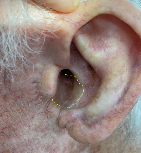 Broken line is a section of full-thickness skin