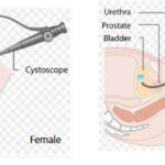 Cystoscopy
