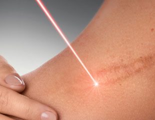 Chi phí điều trị nám bằng laser là bao nhiêu?
