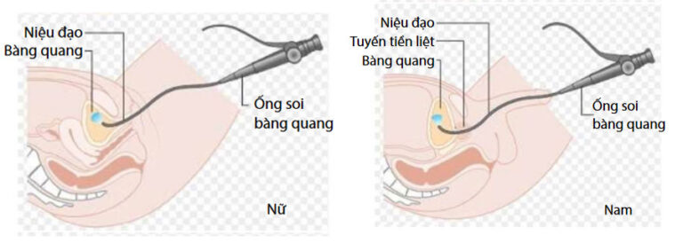 Nội soi bàng quang