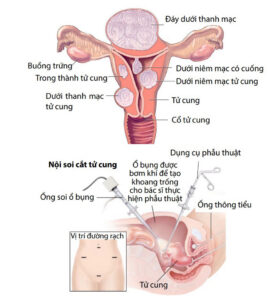 Thủ Thuật Bào Mô Qua Nội Soi Ổ Bụng