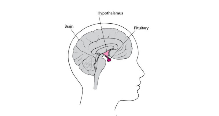 Growth Hormone Deficiency