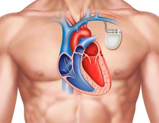 Máy đặt máy tạo nhịp tim như thế nào và tác dụng của nó
