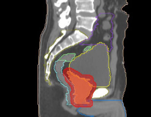 Bowel and Bladder Preparation for Radiotherapy to the Pelvis