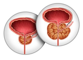 Prostate Artery Embolisation for Benign Prostatic Hyperplasia