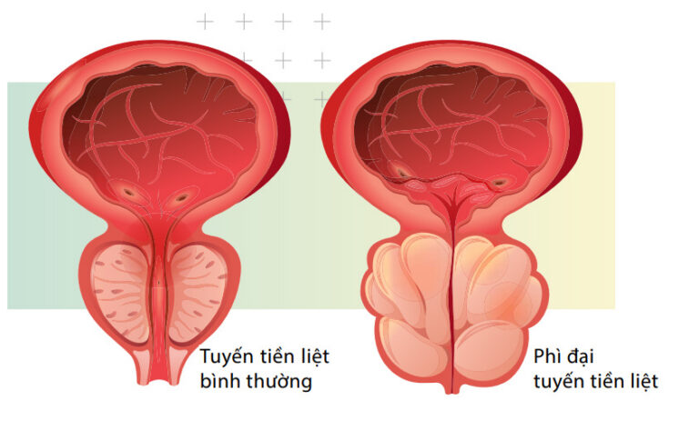 Phương pháp Nút Động mạch Tuyến tiền liệt đối với Phì đại Lành tính Tuyến tiền liệt