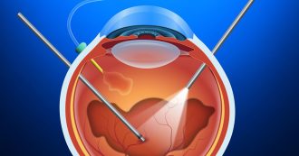 Vitrectomy