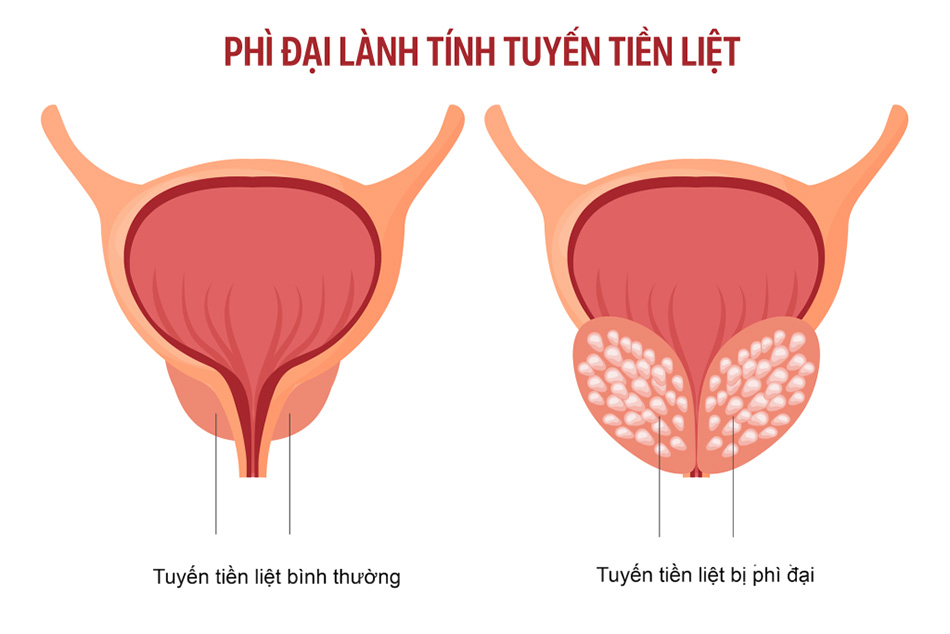 Minh họa tuyến tiền liệt bình thường và khi bị bướu lành tính