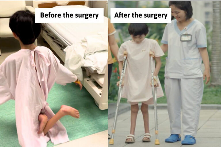 After 12 Years on Her Knees, a Young Girl Walked on Her Own for the First Time