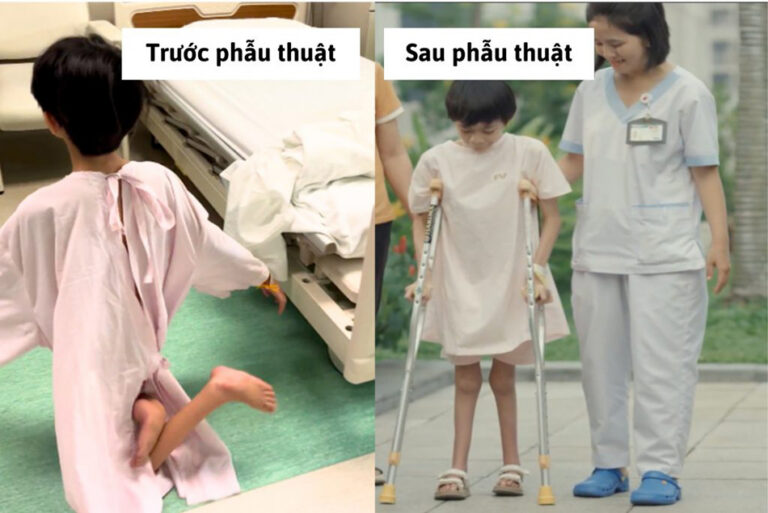 Cô bé 12 tuổi lần đầu đi trên bàn chân sau chục năm đi bằng đầu gối