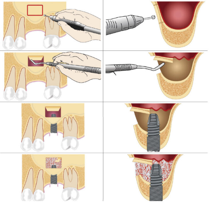 Phẫu Thuật Cấy Ghép Răng
