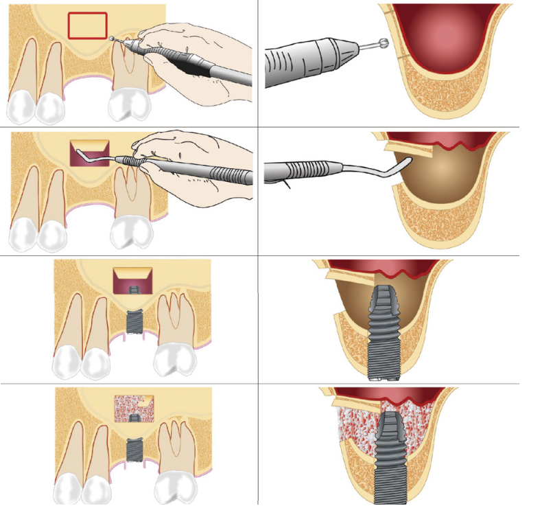 Dental implant with sinus lift and bone grafting