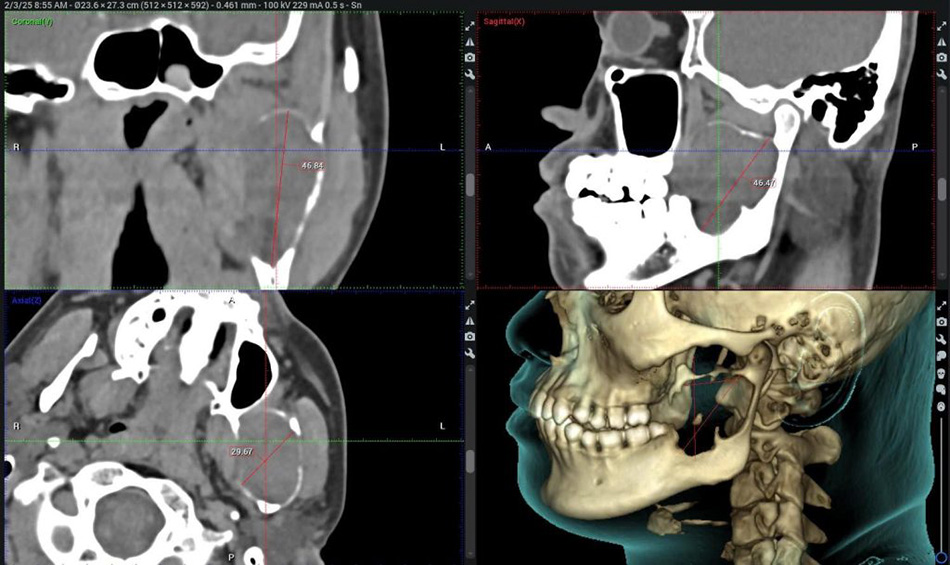 Preserving Facial Structure in a Young Patient with a Large Ameloblastoma