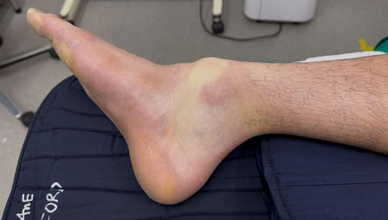 Pickleball Leg Fracture: Doctors of FV Highlight Mistakes Leading to Persistent Injuries