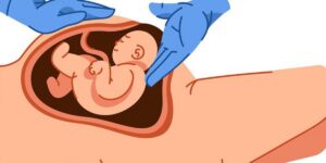 Sinh mổ: Những lưu ý quan trọng để mẹ không mất sữa sau sinh mổ