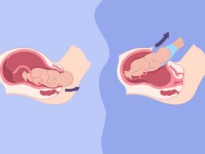Trẻ sinh mổ và sinh thường có gì khác biệt? Tìm hiểu để có cách nuôi con phù hợp
