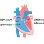 Atrial Fibrillation