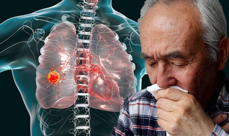 Bệnh ung thư phổi có lây không? Giải đáp khoa học và những lầm tưởng nguy hiểm về ung thư phổi