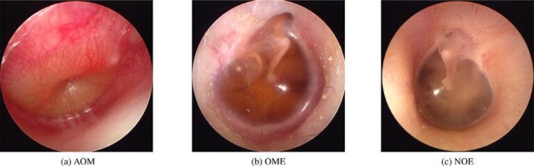 Cách điều trị viêm tai giữa hiệu quả, tối ưu thời gian điều trị
