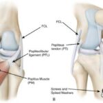 Dấu hiệu của đứt dây chằng chéo trước và đứt dây chằng chéo sau