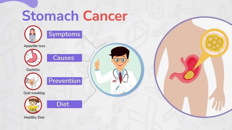 Ung thư dạ dày: Cách nhận biết dấu hiệu của ung thư dạ dày qua từng giai đoạn