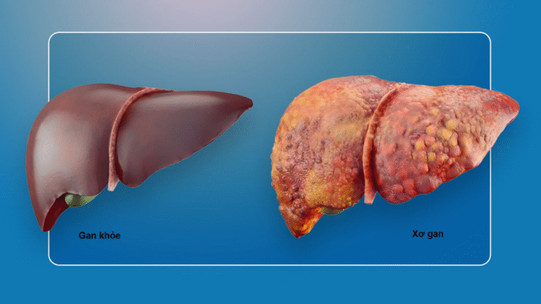 Xơ gan là bệnh gì? Bệnh xơ gan có chữa khỏi được không?