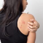 Điều trị ung thư da ở đâu tốt nhất?