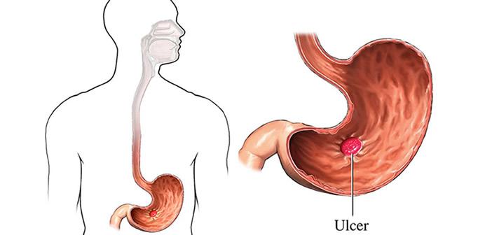 Xác định đúng nguyên nhân viêm loét dạ dày để phòng ngừa và điều trị hiệu quả