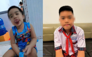 Surgery To Reduce An Enlarged Tongue Helps A 9-Year-Old Boy Regain His Smile