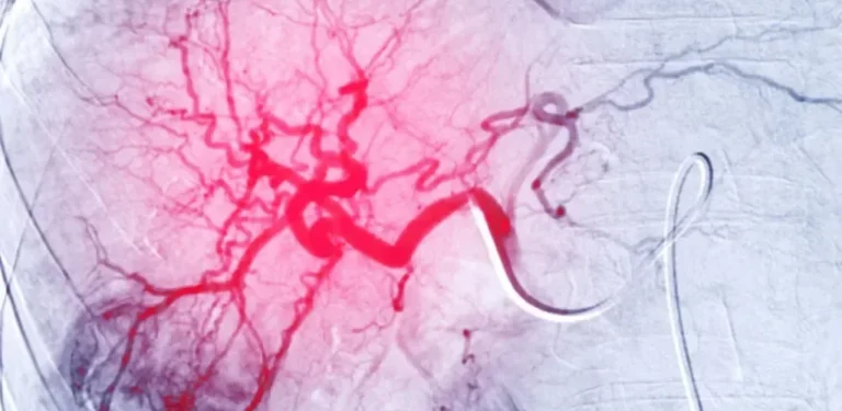 Transarterial Chemoembolisation (TACE) for Liver Cancer