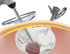 Laparoscopic Morcellation